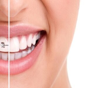 Quickdiagno Dental Braces